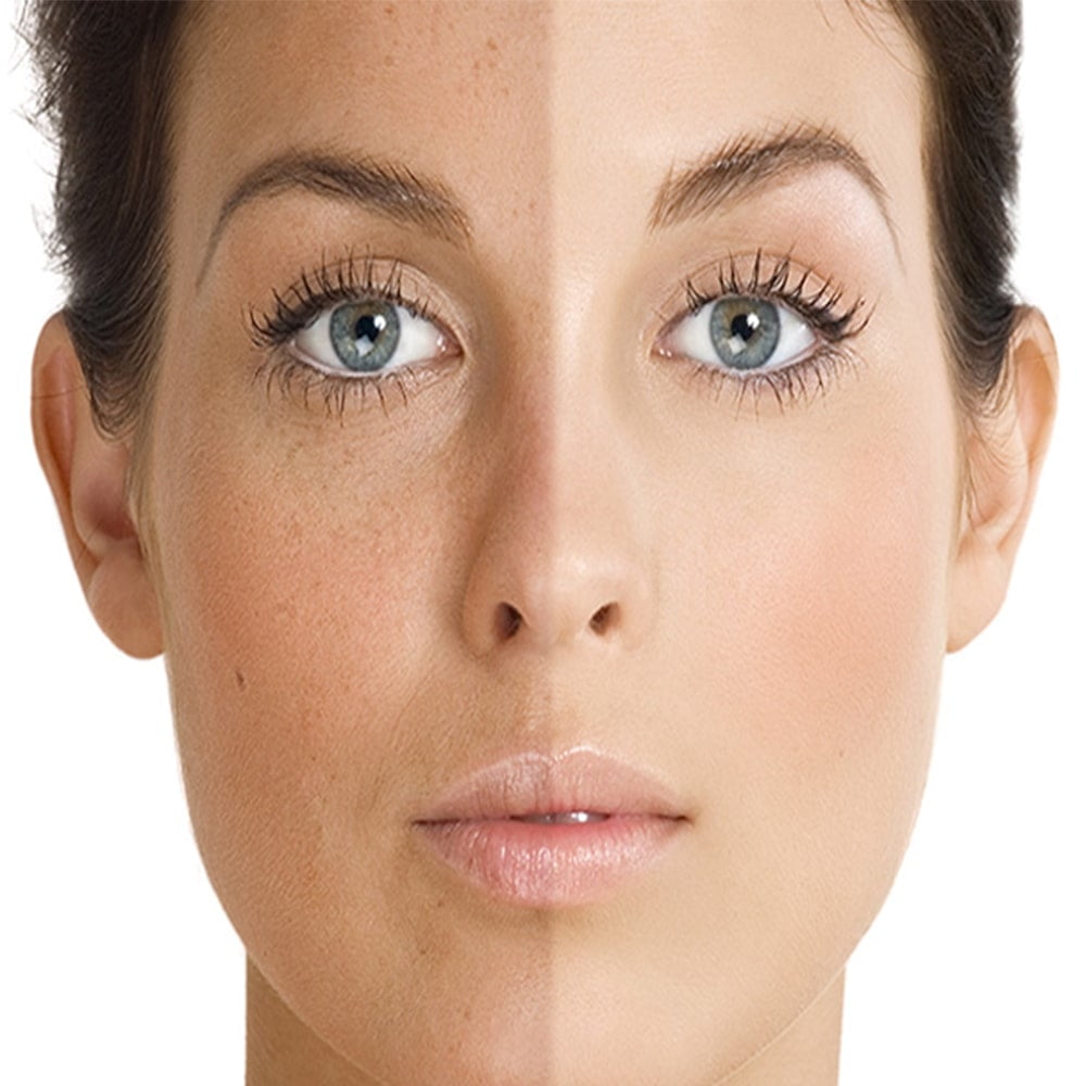 قوی ترین ضدلک های گیاهی