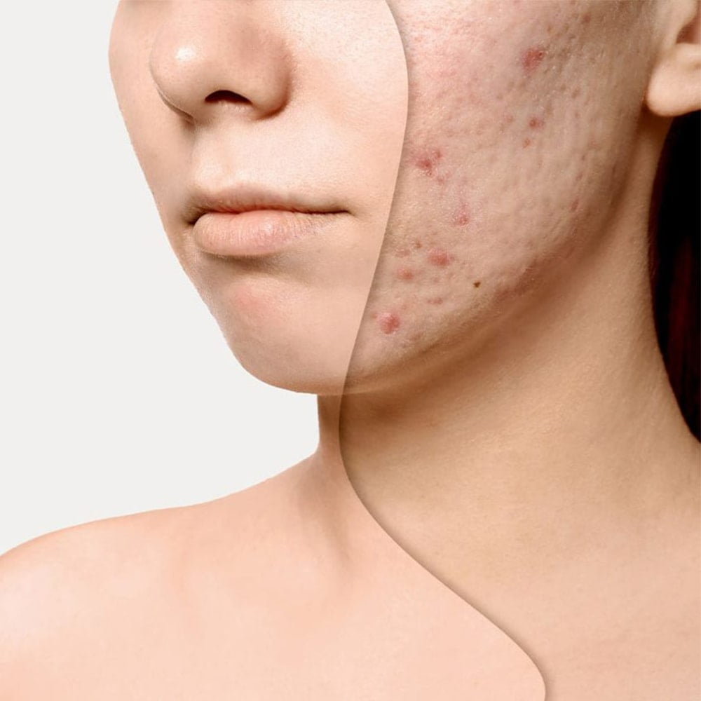 درمان-جوش-های-چرکی