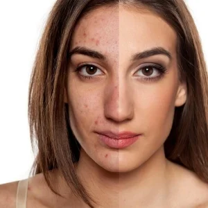 چگونه از شر جای جوش ها خلاص شویم