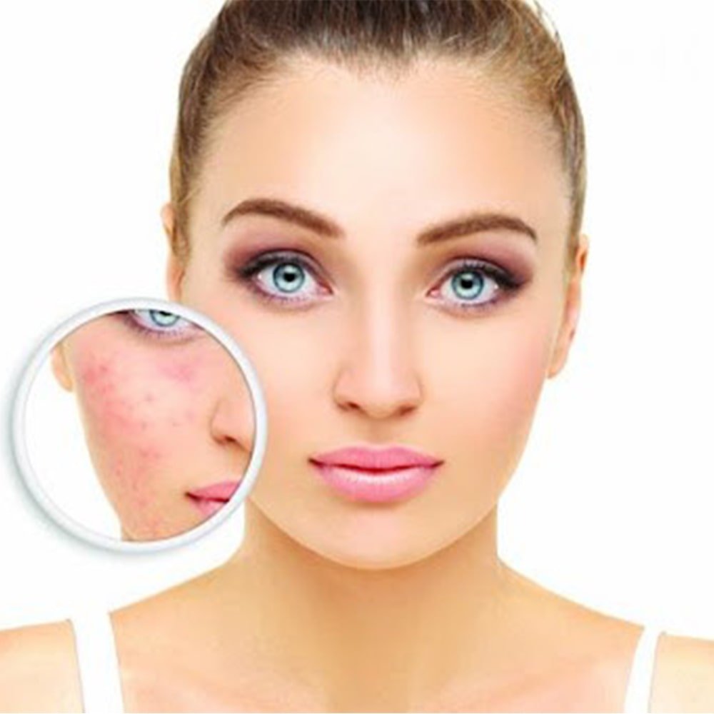 روزاسه-چیست-؟-علل-و-نشانه-ها-و-درمان-آن-چیست