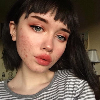 درمان جوش صورت