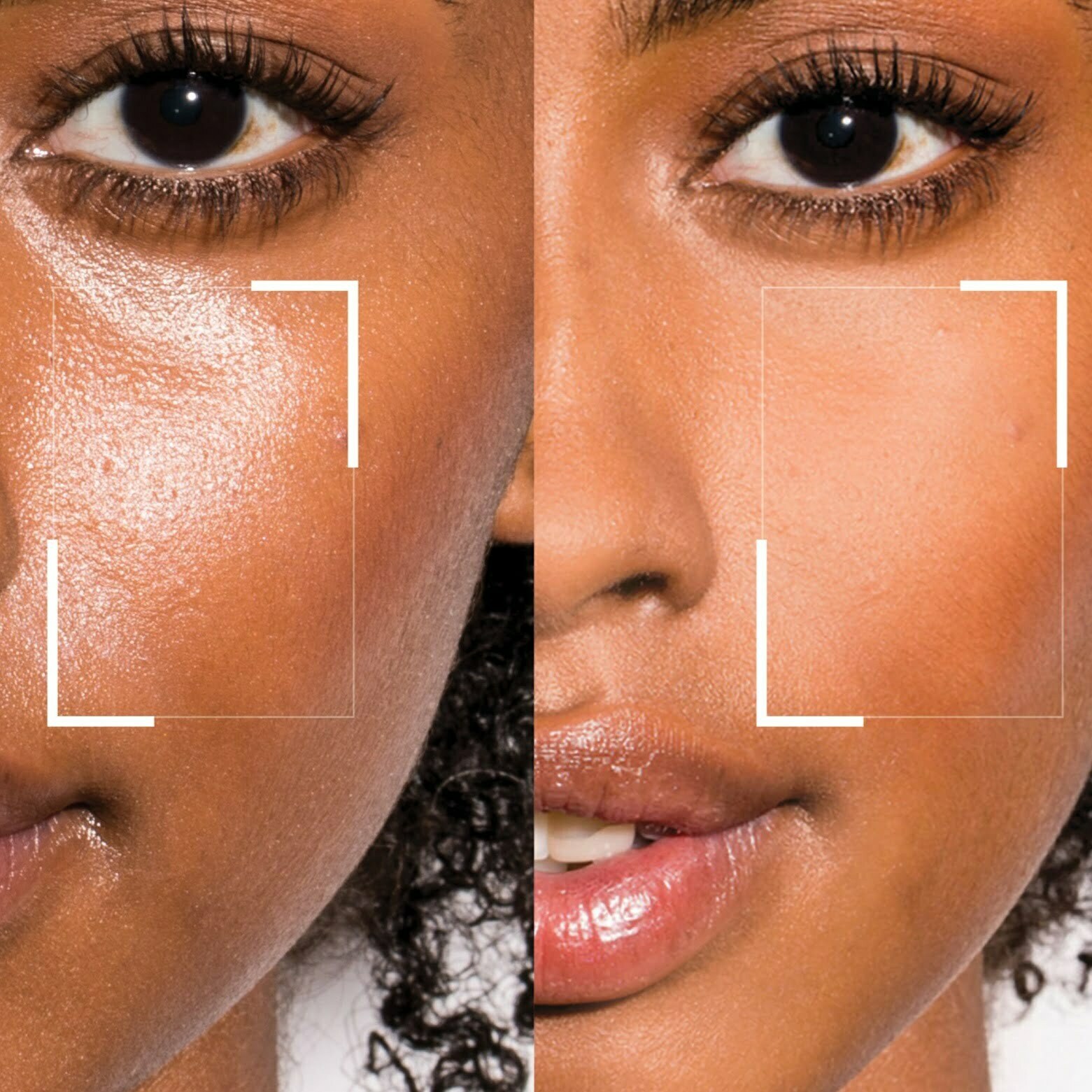 درمان منافذ باز پوستی