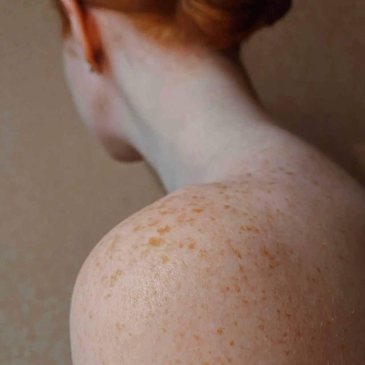 کمبود کدام ویتامین باعث کک و مک میشود