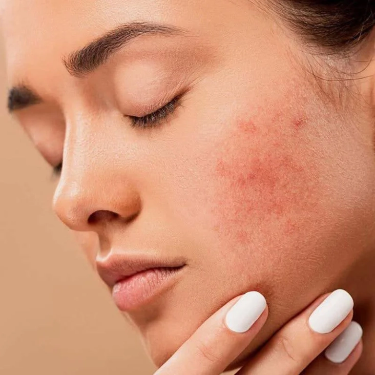 کرم ضد جوش برای پوست چرب