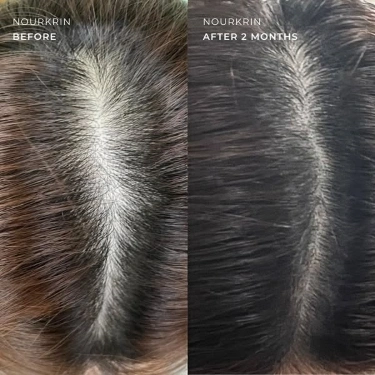 بررسی علمی و تخصصی قرص نورکرین: موثرترین مکمل برای ریزش مو