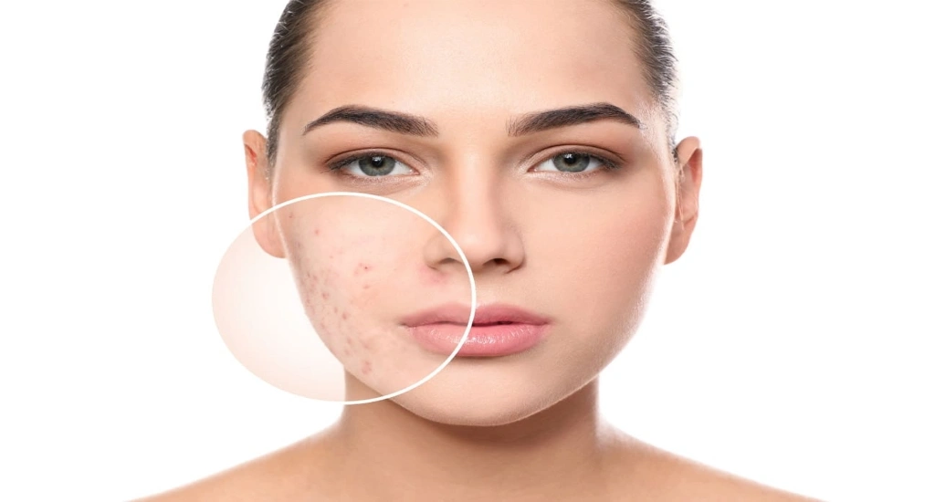 نابودی لک صورت