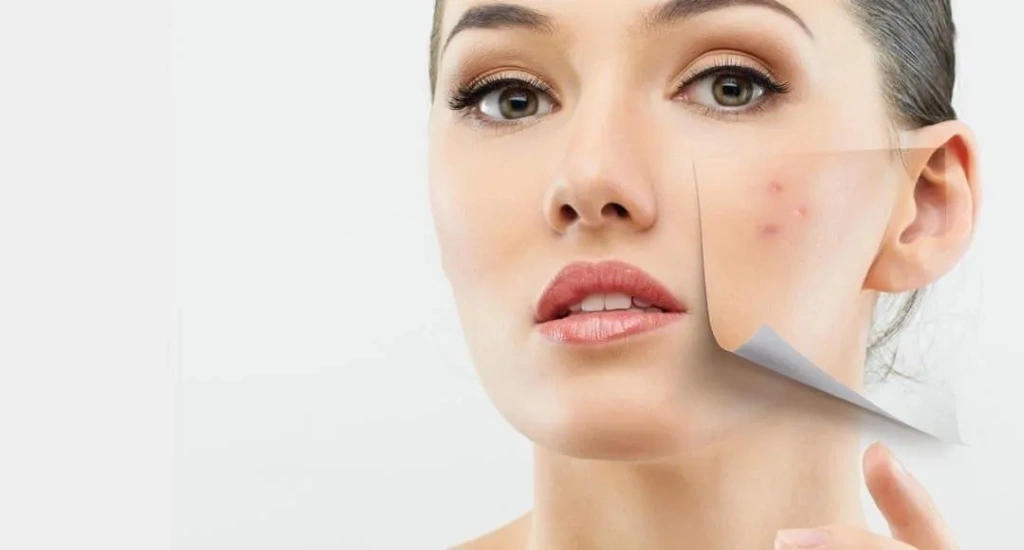 ترانگزامیک اسید