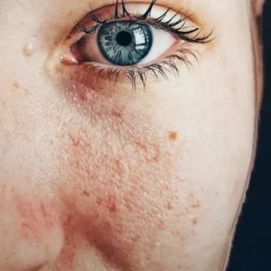 ۶ اشتباه رایج که لک صورت را بدتر می‌کند