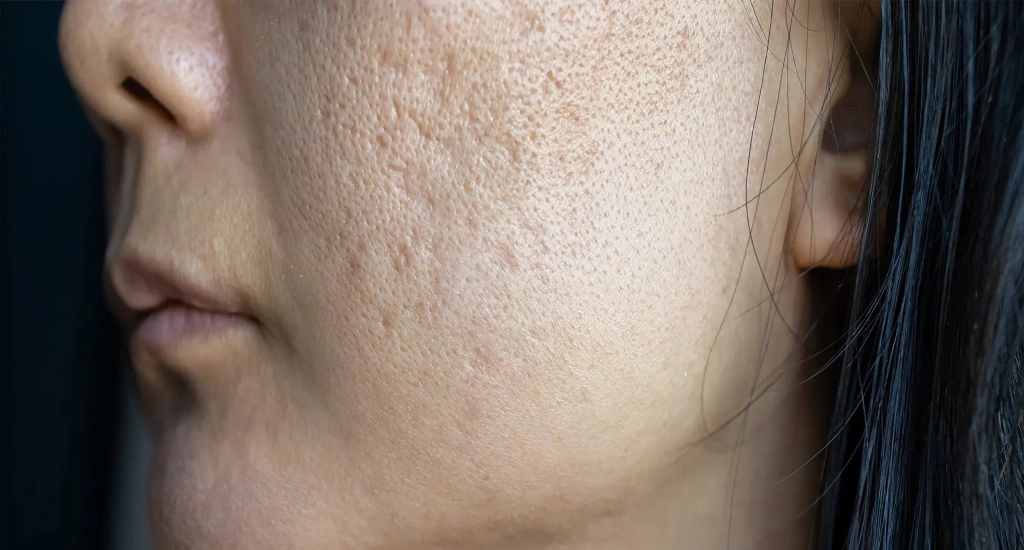 درمان منافذ