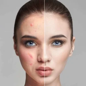 چرا جوش صورت ایجاد می‌شود و بهترین درمان آن چیست؟