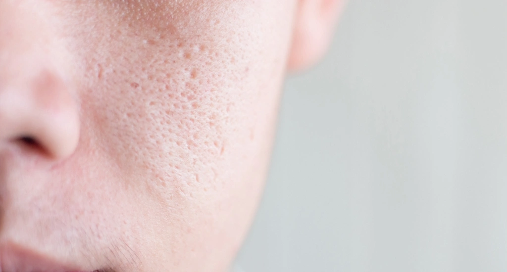 درمان منافذ باز