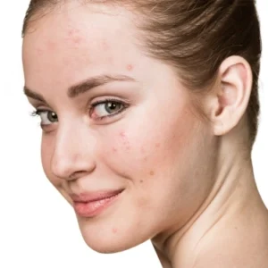 چرا کرم ترمیم کننده باعث جوش میشود؟